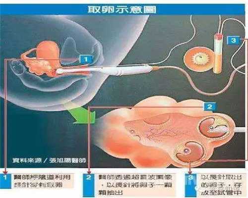 郑州女生捐卵_试管婴儿妇女的卵巢早衰怎么办