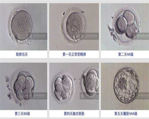 珠海专业捐卵，卵巢畸胎瘤手术后影响生育吗