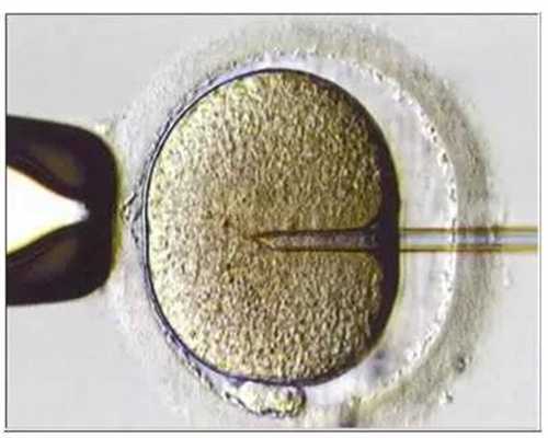 东莞卖卵子联系方式,子宫内膜异位症与不孕症的联系和治疗