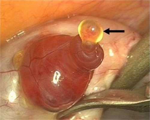 潍坊拉拉捐卵群,用度是几卵巢早衰生孩子供卵流程试管怎样取试管供卵助孕包